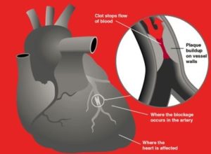 coronaryarterydisease